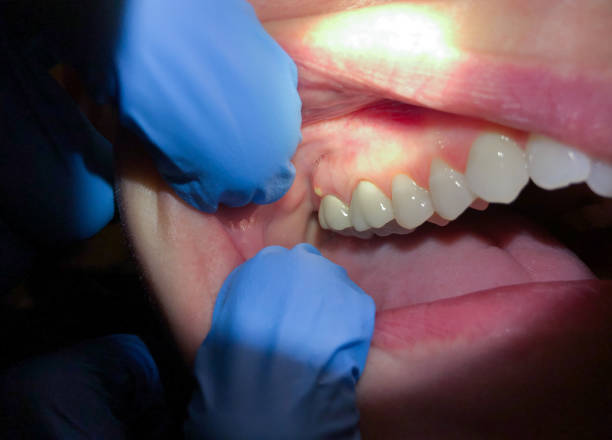 Emergency Dental Filling Replacement in CO